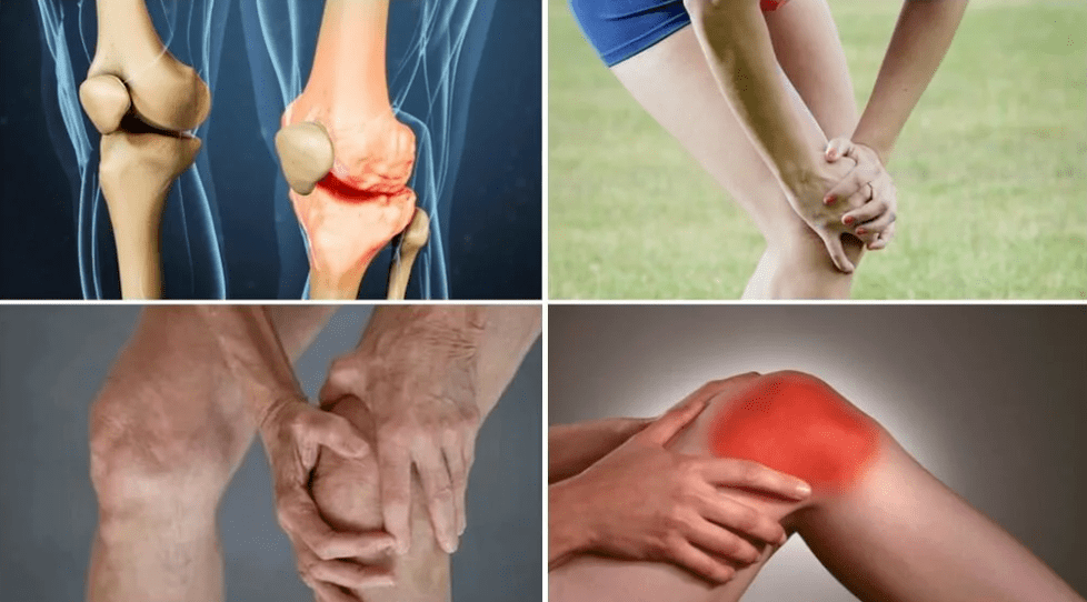 Symptome einer Arthrose