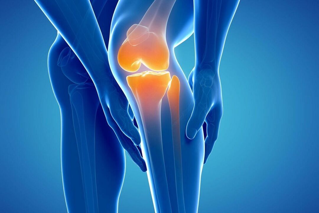 Was ist Arthrose