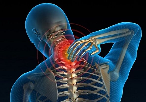 Nackenschmerzen aufgrund von Osteochondrose