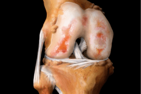 Schädigung des Kniegelenks durch Arthrose.